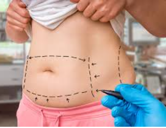 Miami’s Fountain of Beauty: Renewal through Tummy Tuck Mastery