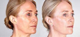 Expert Skin Firming: Facial Tightening Services Close By