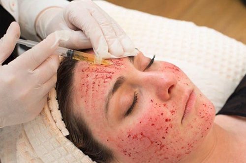 Vampire Facial for Anti-Aging: Does It Work?